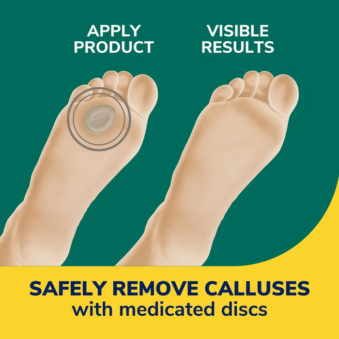 Medicated callus remover discs shown on two bare feet