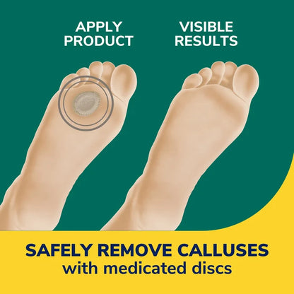 Medicated callus remover discs shown on two bare feet