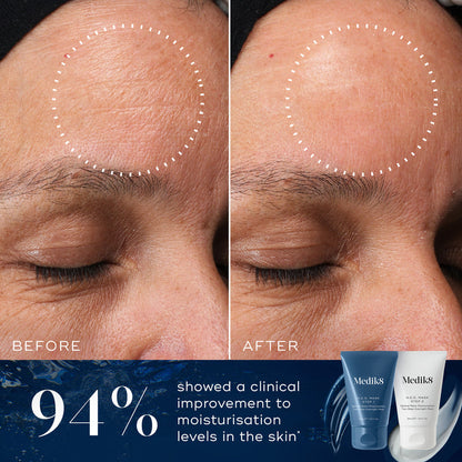 A before and after close-up comparison of a forehead, showing visibly smoother and more hydrated-looking skin in the circled area on the "After" side compared to the "Before" side. Text below states "94% showed a clinical improvement to moisturisation levels in the skin*". Tubes of Medik8 H.E.O. Mask Step 1 and Step 2 are displayed in the corner against a blue background.
