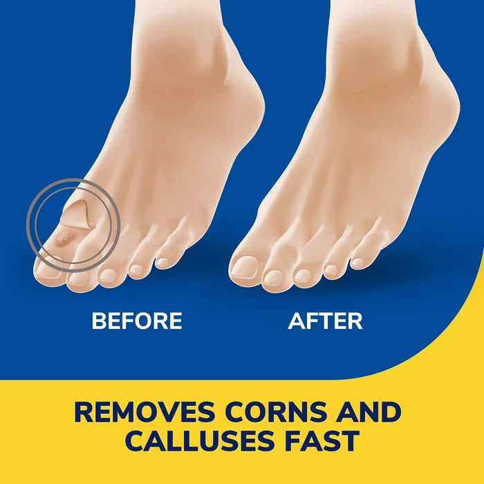 Bare feet with beige cushioned pads over soles for corn and callus treatment