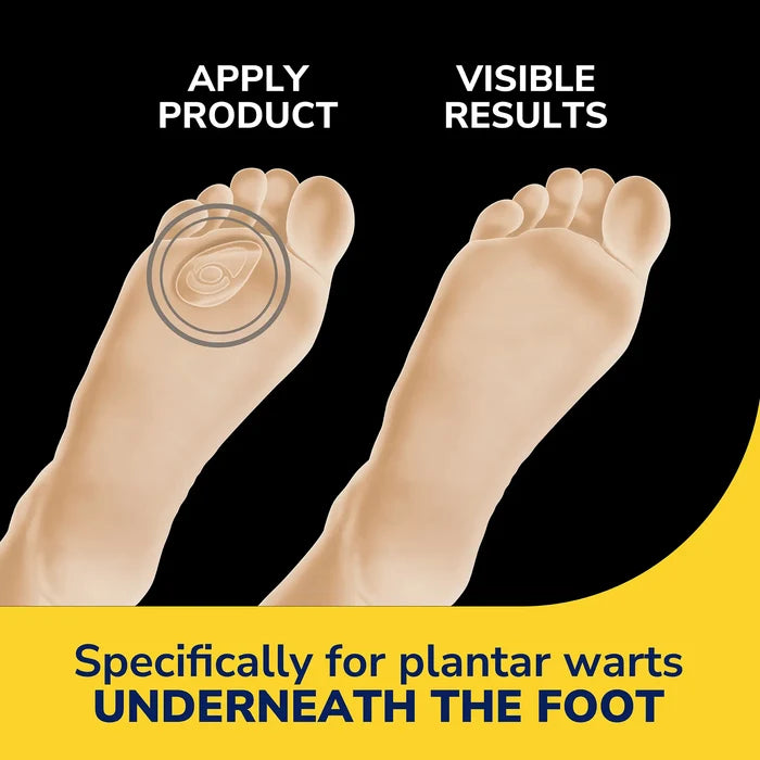 Hydrogel wart remover seal applied on foot sole with visible results graphic
