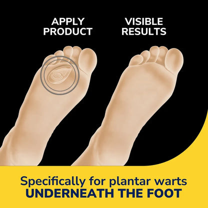Hydrogel wart remover seal applied on foot sole with visible results graphic